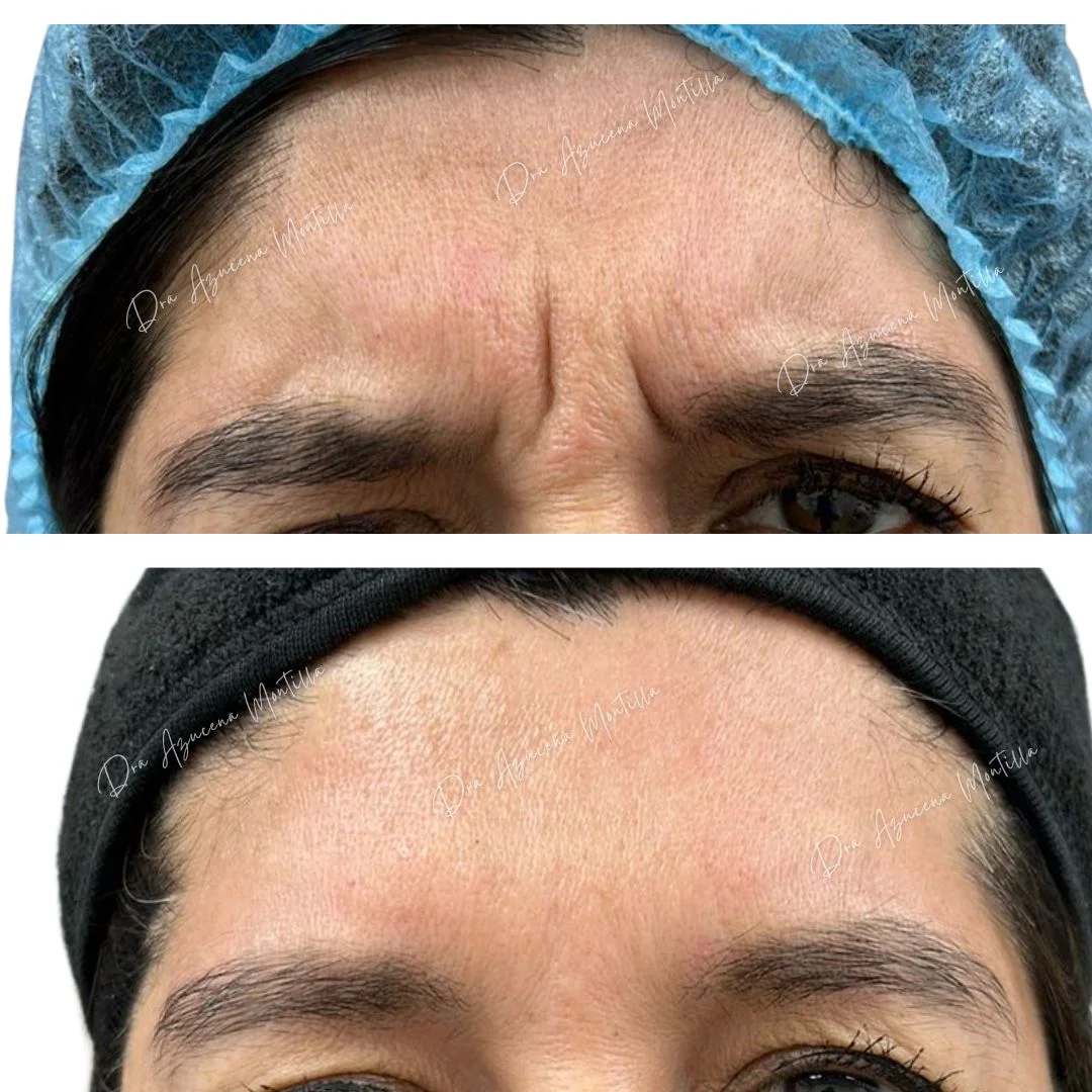 Botox result, frown lines — before and after