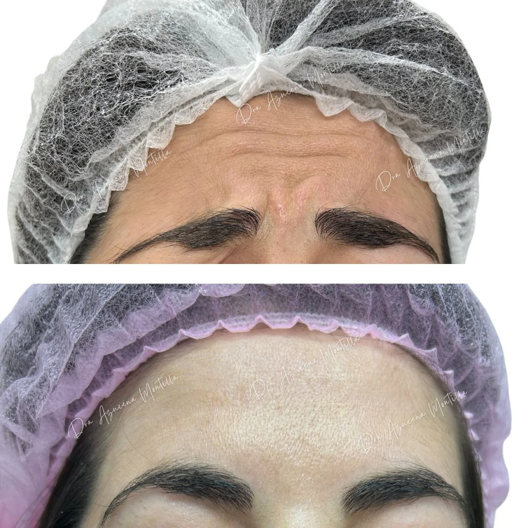 Botox result — before and after