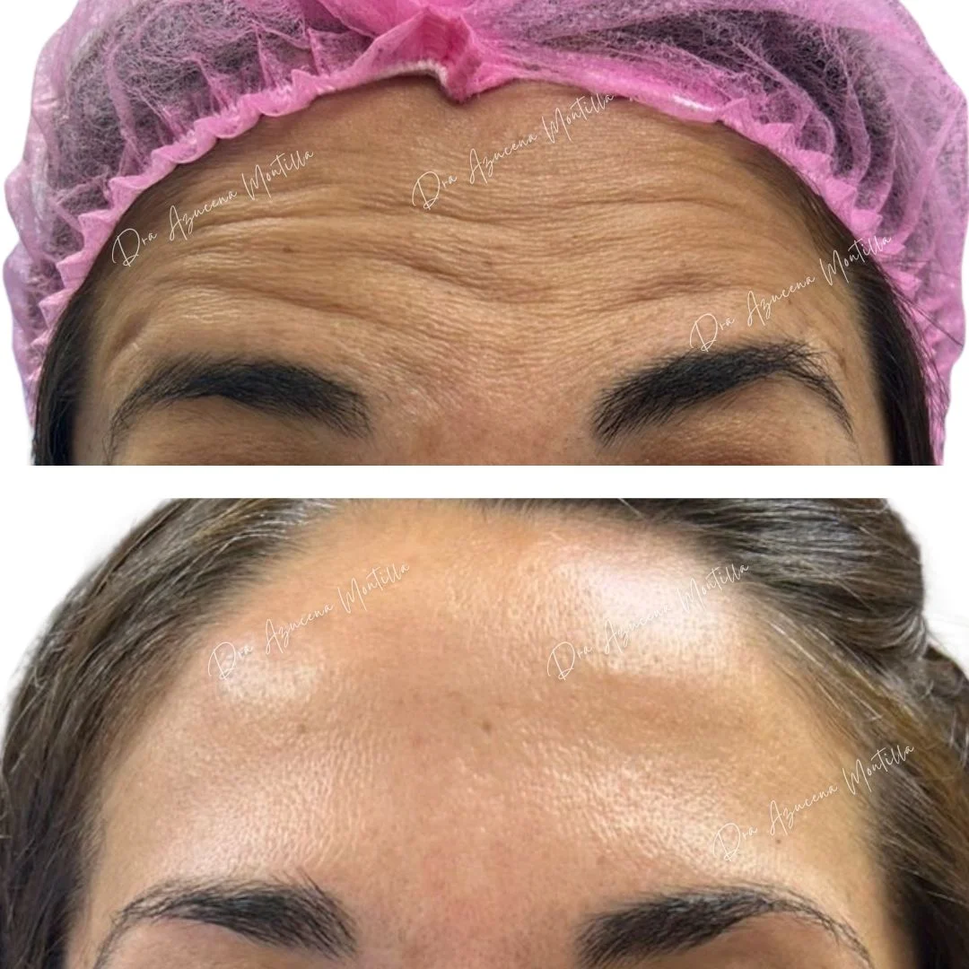 Botox result — before and after