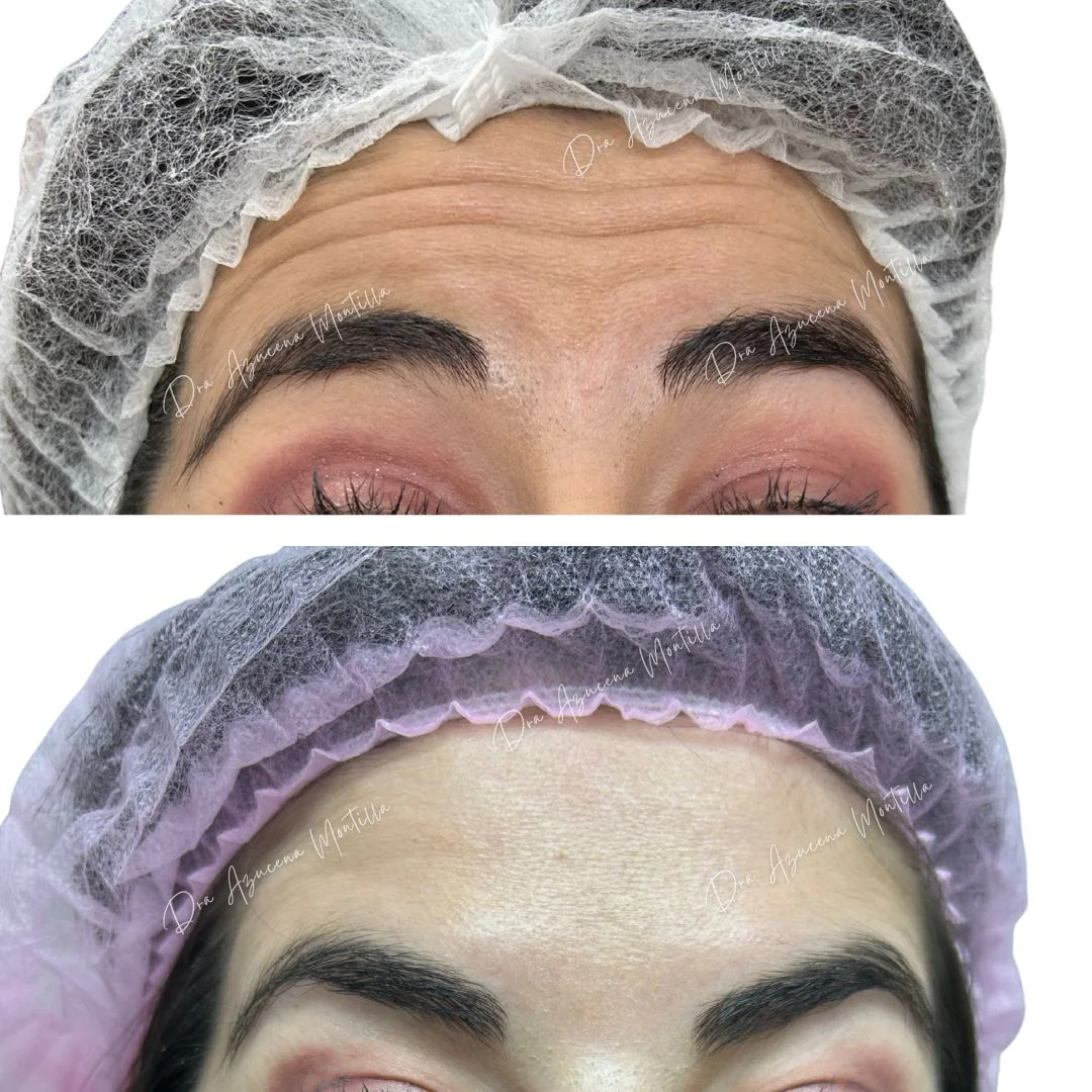 Botox result — before and after