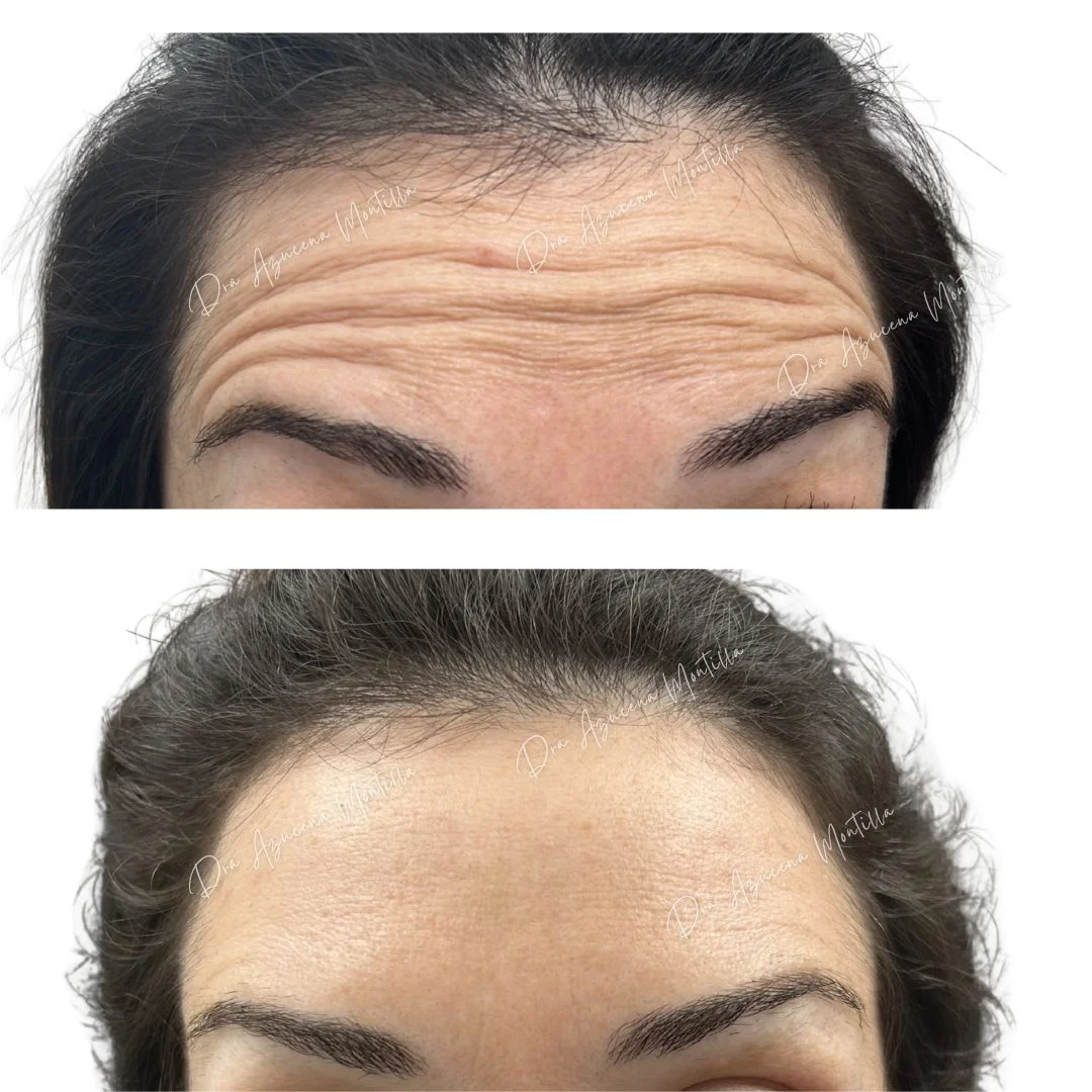 Botox result — before and after